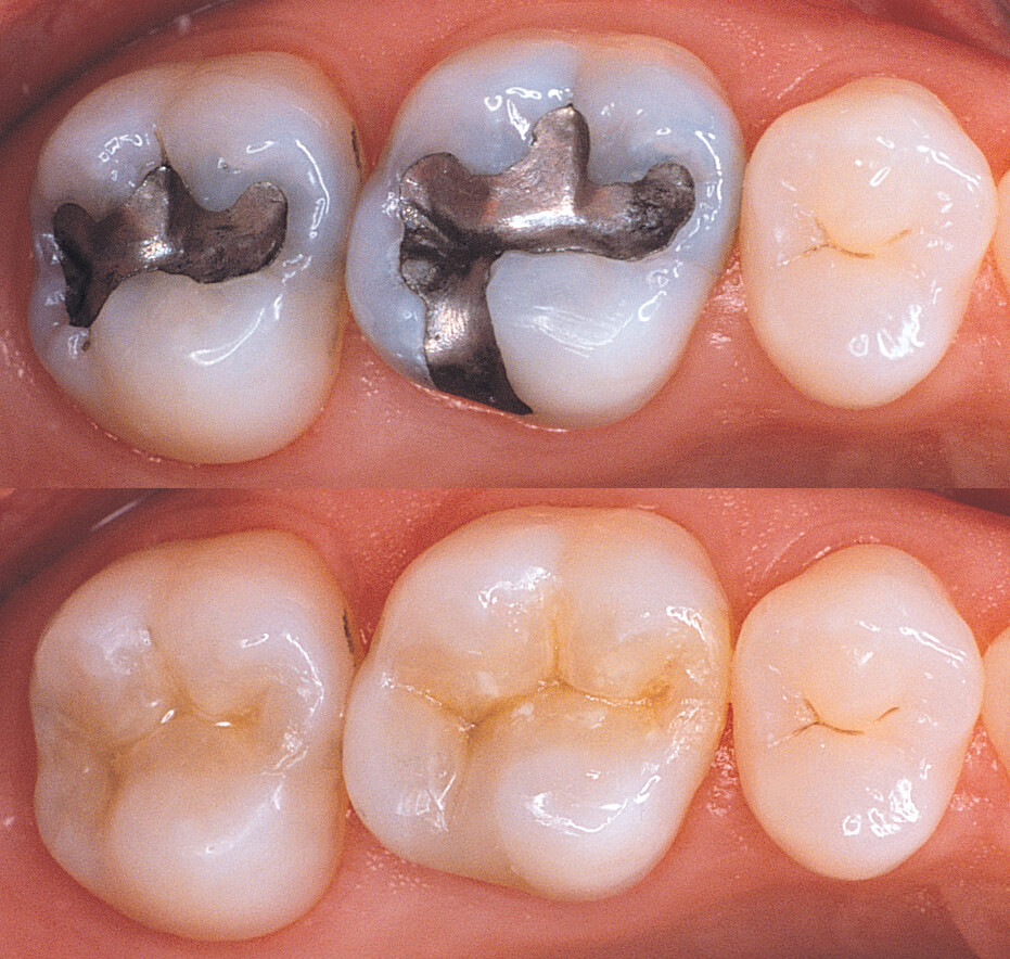 Advanced Dental Tooth Color Fillings Treatment, Dentist, Clinics