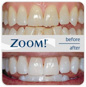 what can you eat after zoom whitening